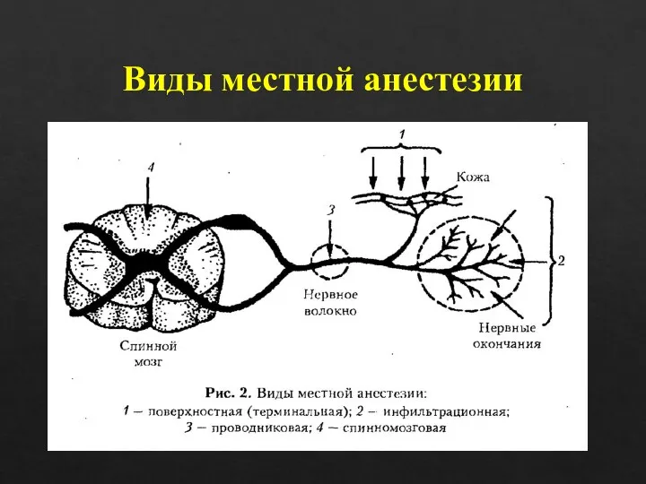 Виды местной анестезии