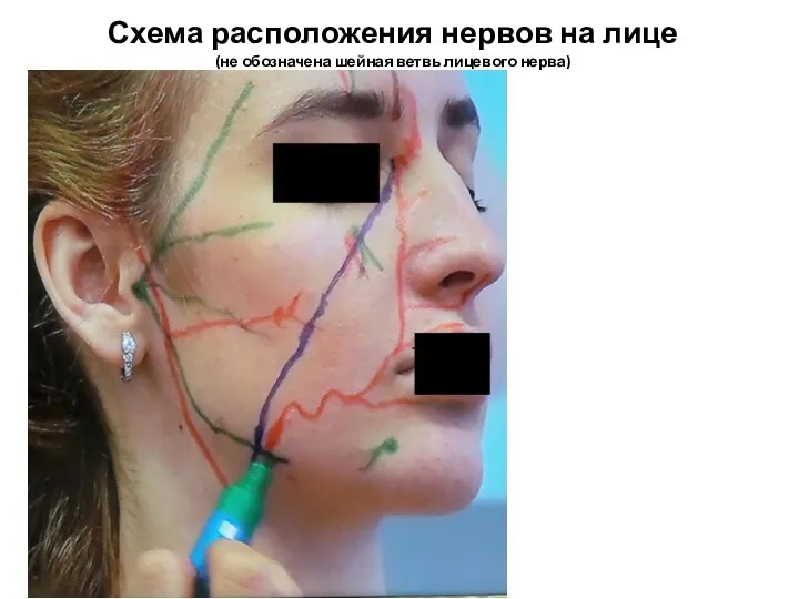 Схема расположения нервов на лице (не обозначена шейная ветвь лицевого нерва)