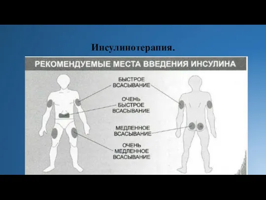 Инсулинотерапия.