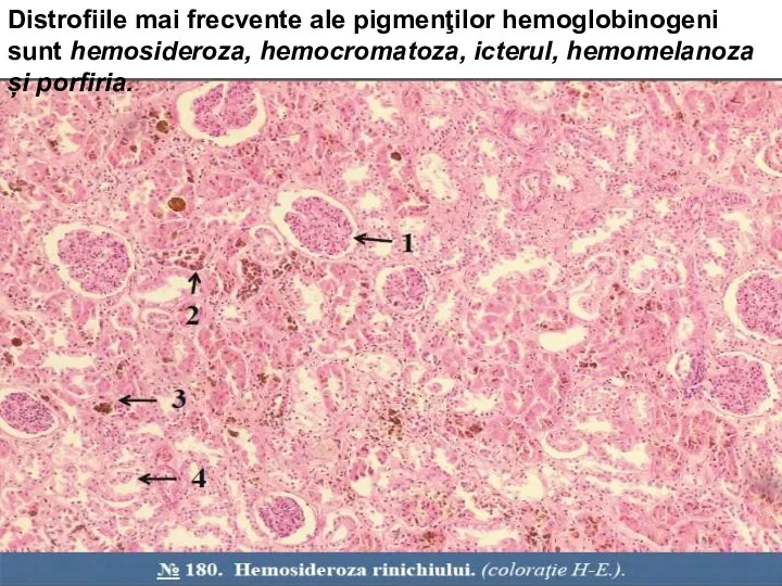 Distrofiile mai frecvente ale pigmenţilor hemoglobinogeni sunt hemosideroza, hemocromatoza, icterul, hemomelanoza și porfiria.