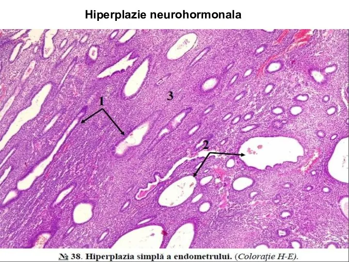 Hiperplazie neurohormonala