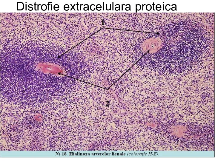 Distrofie extracelulara proteica