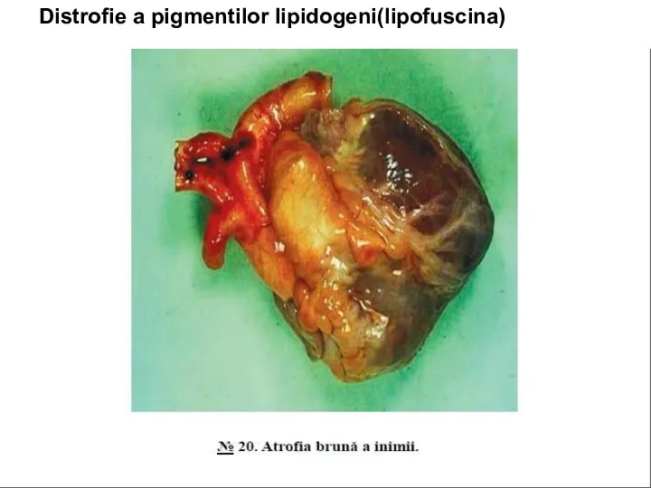 Distrofie a pigmentilor lipidogeni(lipofuscina)