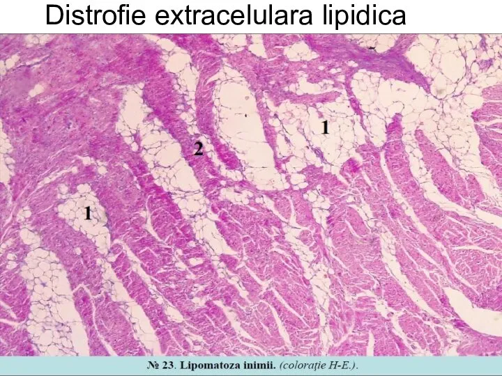 Distrofie extracelulara lipidica