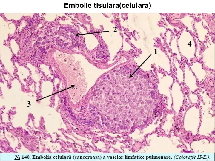 Embolie tisulara(celulara)