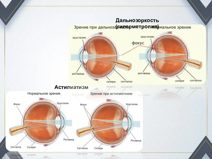 Астигматизм Дальнозоркость (гиперметропия)