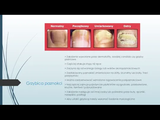 Grzybica paznokci > Zakażenie wywołane przez dermatofity, rzadziej candida czy grzyby pleśniowe