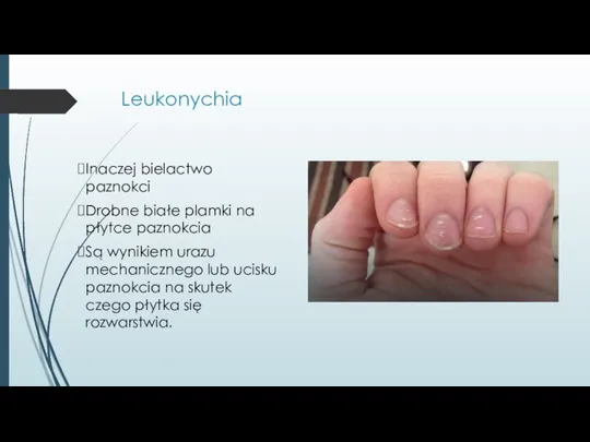 Leukonychia Inaczej bielactwo paznokci Drobne białe plamki na płytce paznokcia Są wynikiem