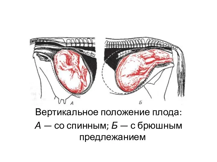 Вертикальное положение плода: А — со спинным; Б — с брюшным предлежанием