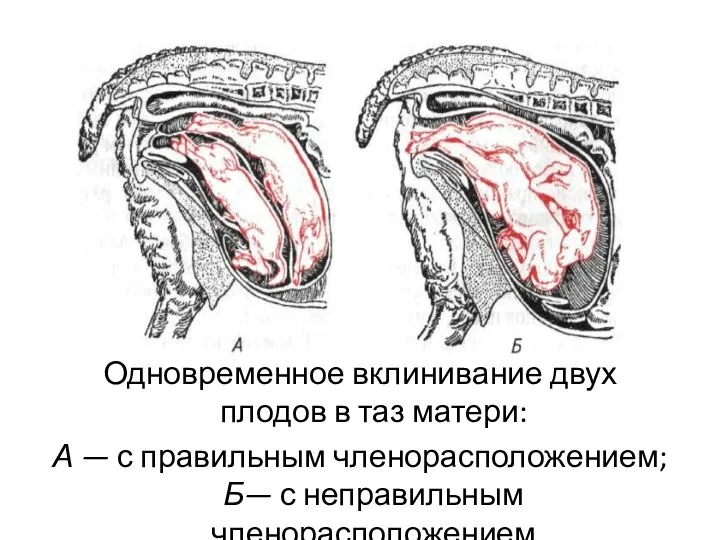 Одновременное вклинивание двух плодов в таз матери: А — с правильным членорасположением; Б— с неправильным членорасположением