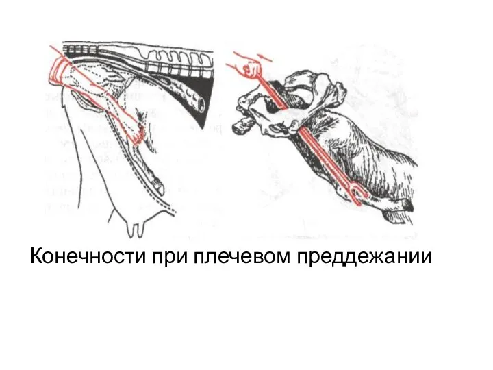 Конечности при плечевом преддежании