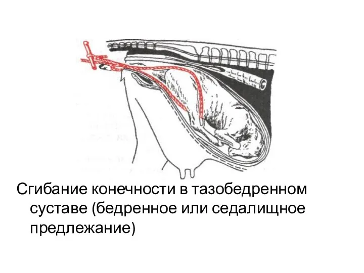 Сгибание конечности в тазобедренном суставе (бедренное или седалищное предлежание)