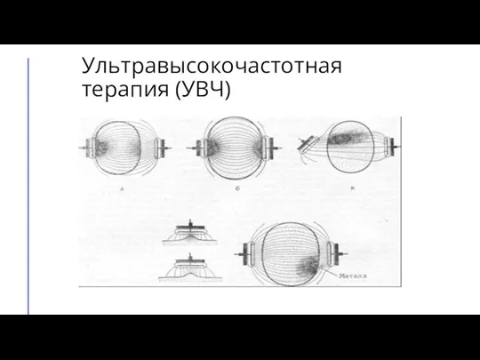 Ультравысокочастотная терапия (УВЧ)