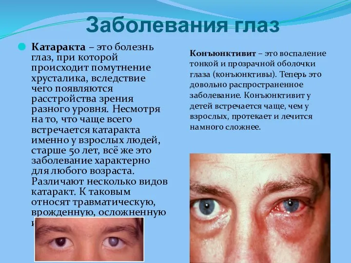 Заболевания глаз Катаракта – это болезнь глаз, при которой происходит помутнение хрусталика,
