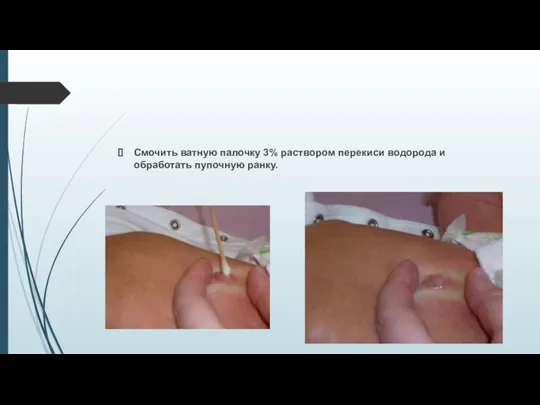 Смочить ватную палочку 3% раствором перекиси водорода и обработать пупочную ранку.