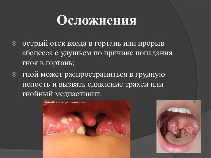 Осложнения острый отек входа в гортань или прорыв абсцесса с удушьем по