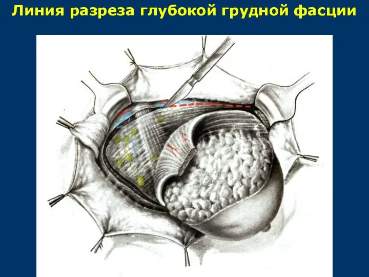 Линия разреза глубокой грудной фасции