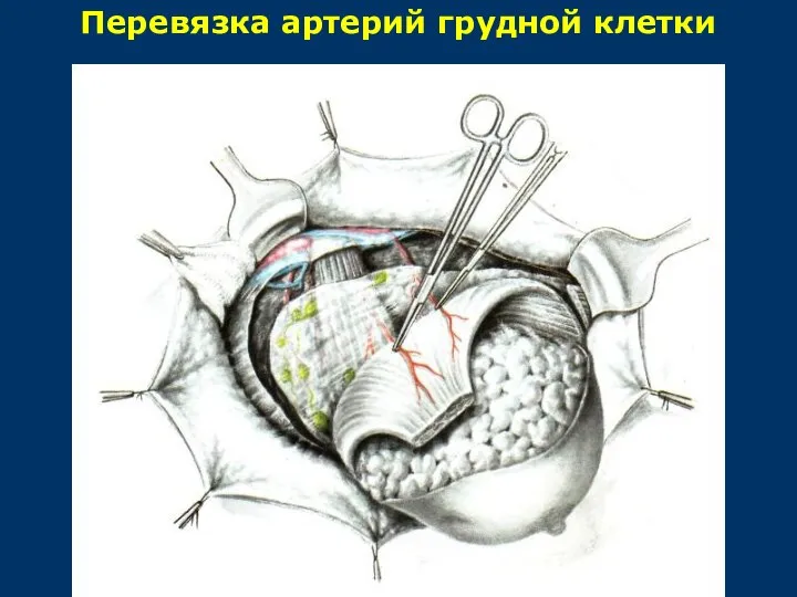 Перевязка артерий грудной клетки