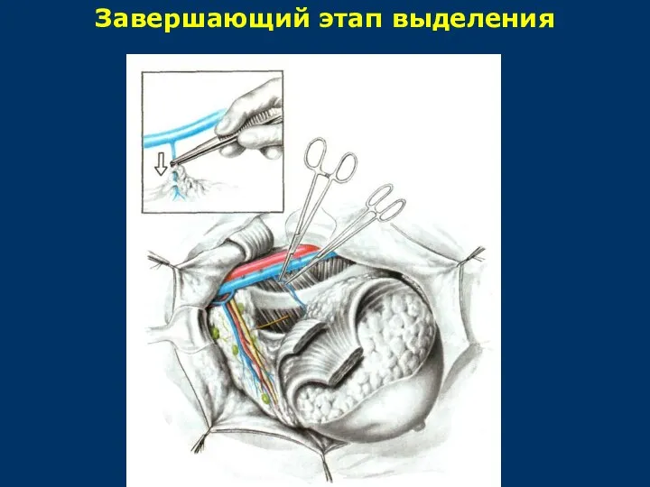 Завершающий этап выделения