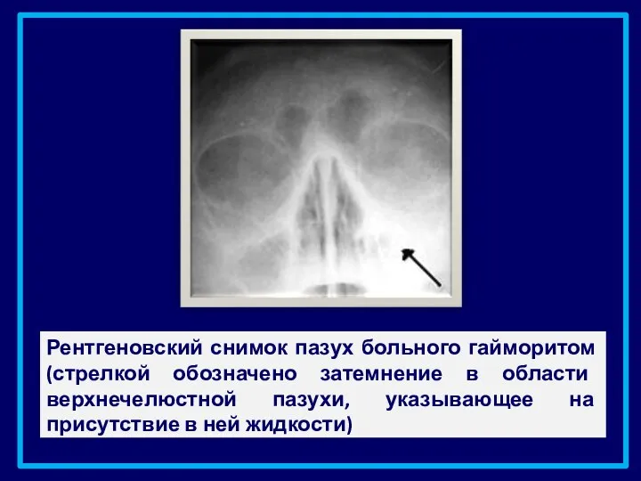 Рентгеновский снимок пазух больного гайморитом (стрелкой обозначено затемнение в области верхнечелюстной пазухи,