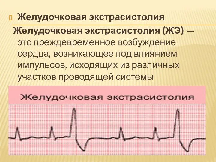 Желудочковая экстрасистолия Желудочковая экстрасистолия (ЖЭ) — это преждевременное возбуждение сердца, возникающее под