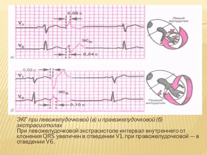 ЭКГ при левожелудочковой (а) и правожелудочковой (б) экстрасистолах При левожелудочковой экстрасистоле интервал