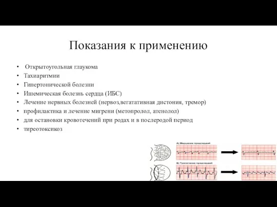 Показания к применению Открытоугольная глаукома Тахиаритмии Гипертонической болезни Ишемическая болезнь сердца (ИБС)