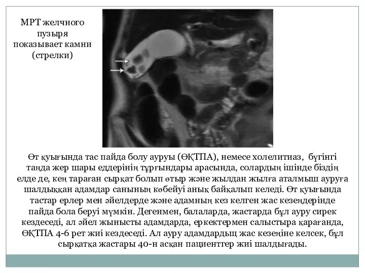 Өт қуығында тас пайда болу ауруы (ӨҚТПА), немесе холелитиаз, бүгінгі таңда жер