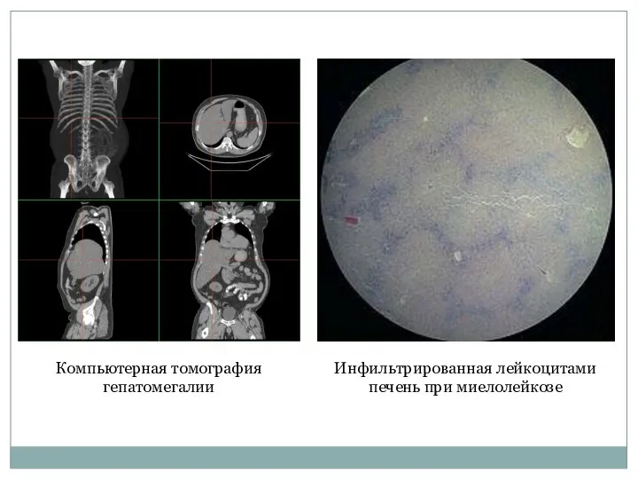 Компьютерная томография гепатомегалии Инфильтрированная лейкоцитами печень при миелолейкозе