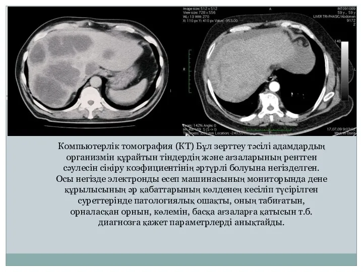 Компьютерлік томография (КТ) Бұл зерттеу тәсілі адамдардың организмін құрайтын тіндердің және ағзаларының