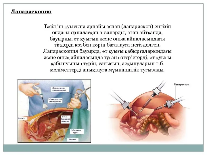 Лапараскопия Тәсіл іш қуысына арнайы аспап (лапараскоп) енгізіп ондағы орналасқан ағзаларды, атап