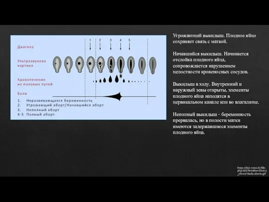 https://do2.vsmu.by/file.php/623/Petukhov/Ostryi_zhivot/Stadii-aborta.gif Угрожающий выкидыш. Плодное яйцо сохраняет связь с маткой. Начавшийся выкидыш. Начинается