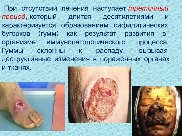 При отсутствии лечения наступает третичный период, который длится десятилетиями и характеризуется образованием