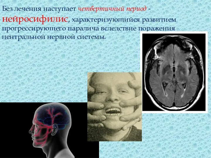 Без лечения наступает четвертичный период - нейросифилис, характеризующийся развитием прогрессирующего паралича вследствие поражения центральной нервной системы.