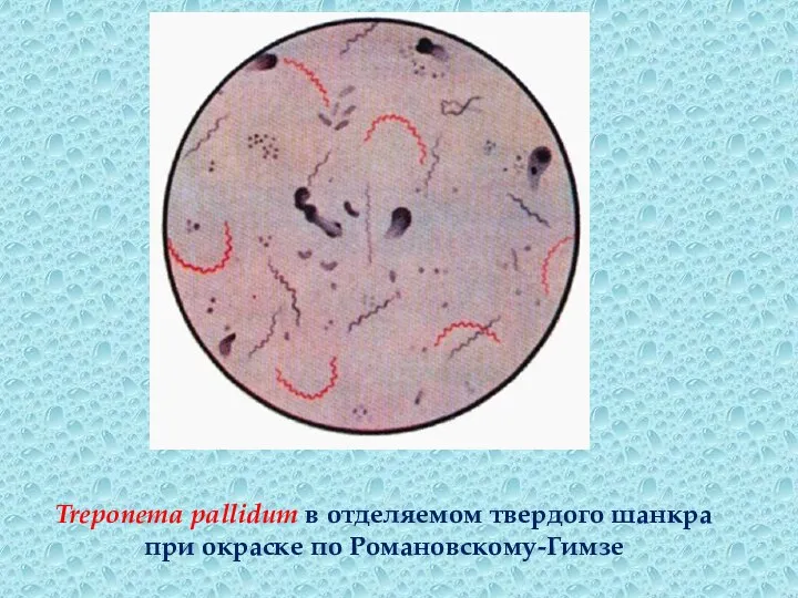 Treponema pallidum в отделяемом твердого шанкра при окраске по Романовскому-Гимзе