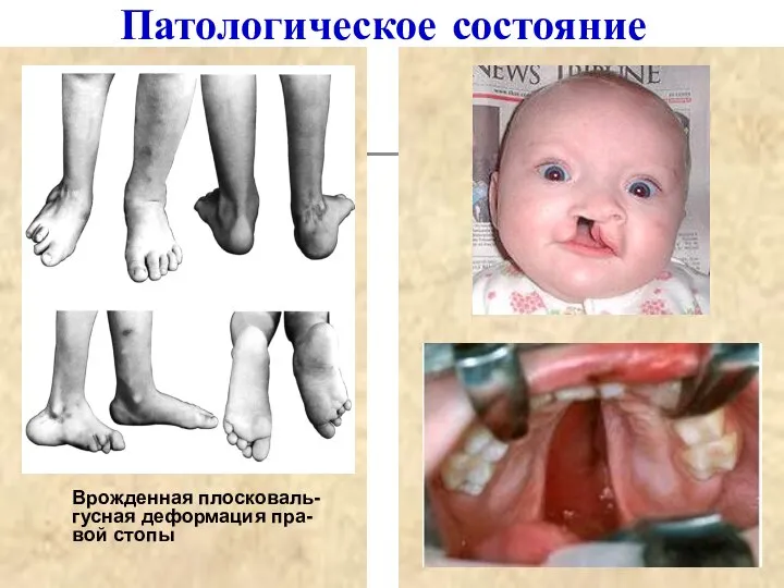 Патологическое состояние Врожденная плосковаль-гусная деформация пра-вой стопы