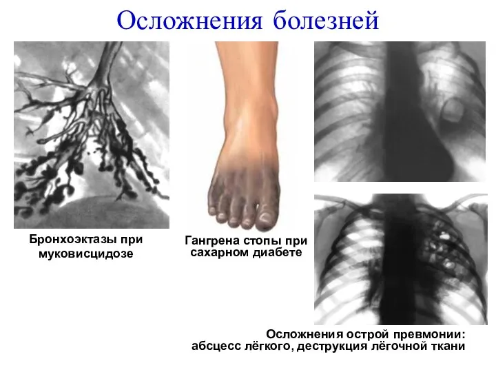 Осложнения болезней Гангрена стопы при сахарном диабете Бронхоэктазы при муковисцидозе Осложнения острой