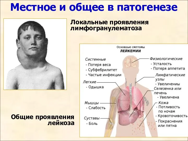 Локальные проявления лимфогранулематоза Общие проявления лейкоза Местное и общее в патогенезе