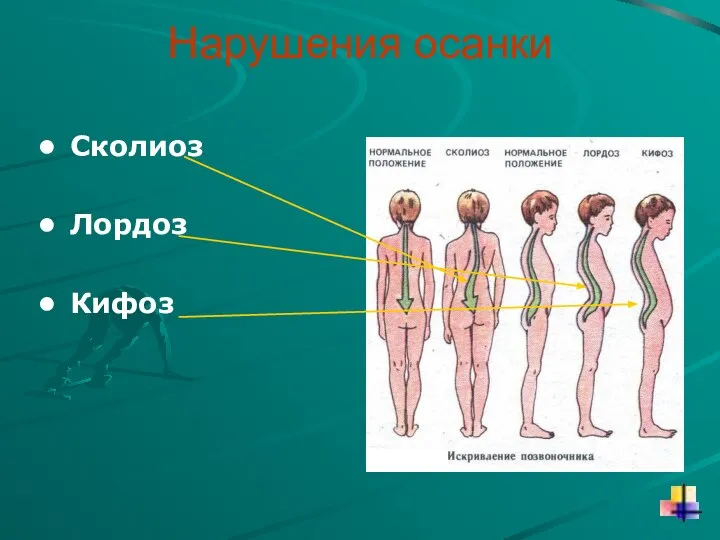 Нарушения осанки Сколиоз Лордоз Кифоз