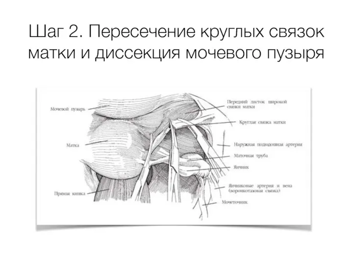 Шаг 2. Пересечение круглых связок матки и диссекция мочевого пузыря