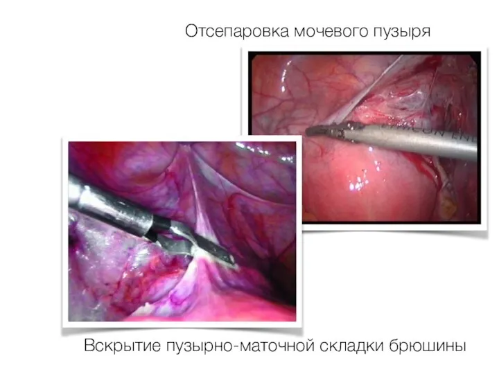 Вскрытие пузырно-маточной складки брюшины Отсепаровка мочевого пузыря