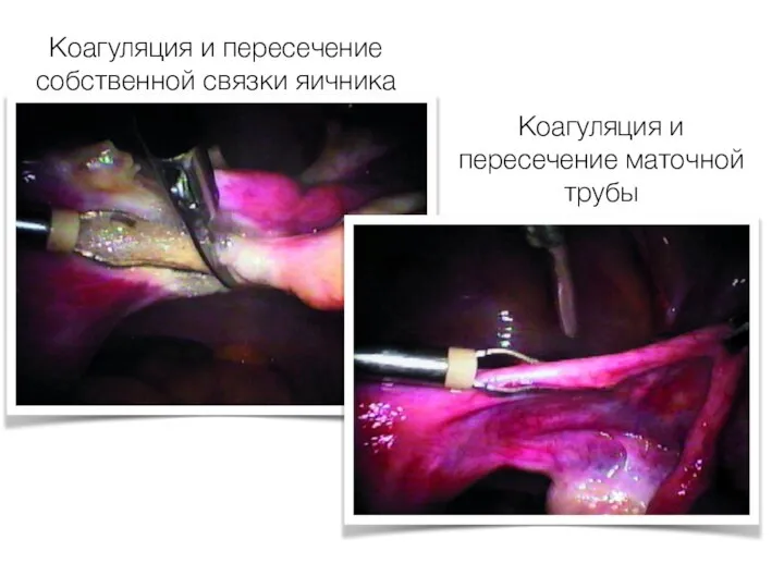 Коагуляция и пересечение собственной связки яичника Коагуляция и пересечение маточной трубы