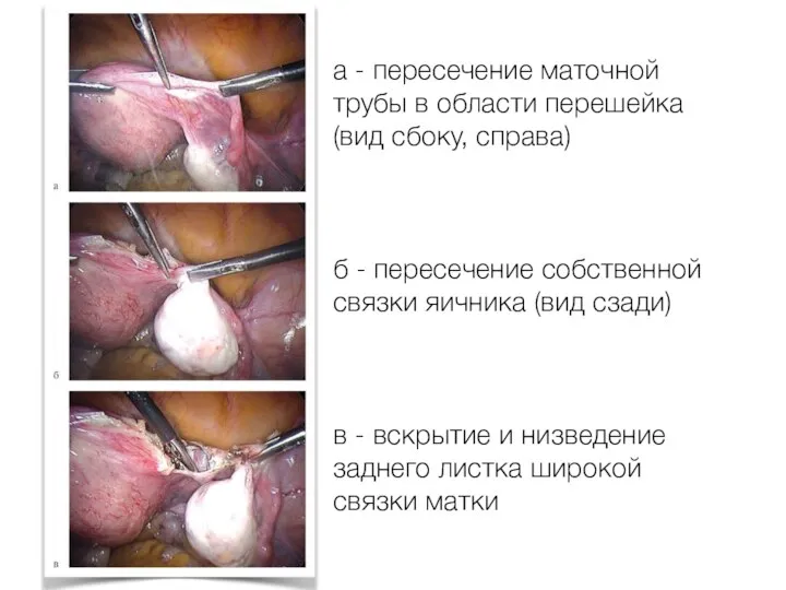а - пересечение маточной трубы в области перешейка (вид сбоку, справа) б
