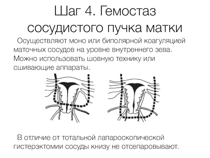 Шаг 4. Гемостаз сосудистого пучка матки Осуществляют моно или биполярной коагуляцией маточных