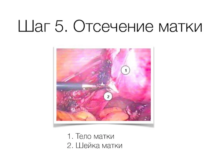 Шаг 5. Отсечение матки 1. Тело матки 2. Шейка матки