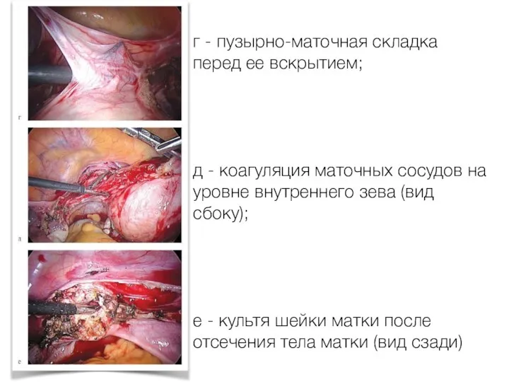 г - пузырно-маточная складка перед ее вскрытием; д - коагуляция маточных сосудов