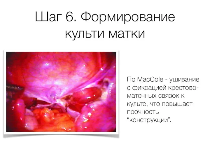 Шаг 6. Формирование культи матки По MacCole - ушивание с фиксацией крестово-маточных