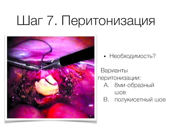 Шаг 7. Перитонизация Необходимость? Варианты перитонизации: 8ми-образный шов полукисетный шов