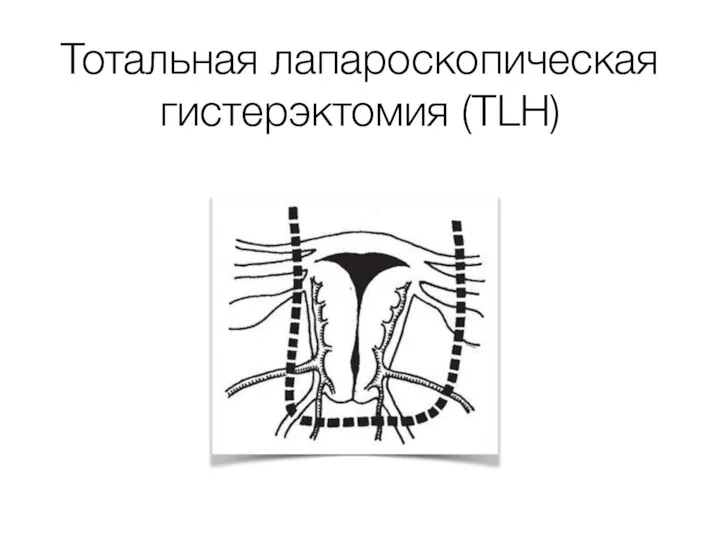 Тотальная лапароскопическая гистерэктомия (TLH)