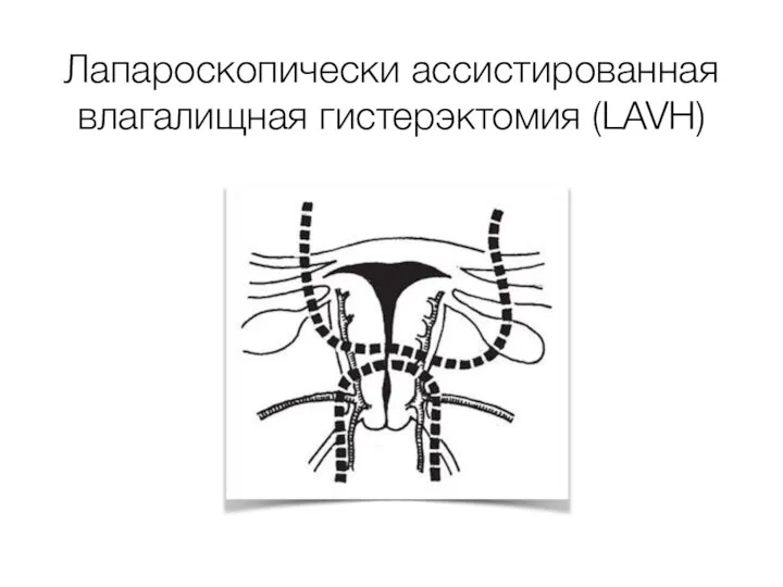 Лапароскопически ассистированная влагалищная гистерэктомия (LAVH)